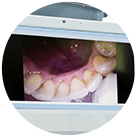 intraoral cameras