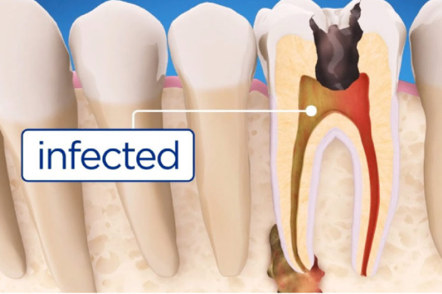 illustration of root canal infection