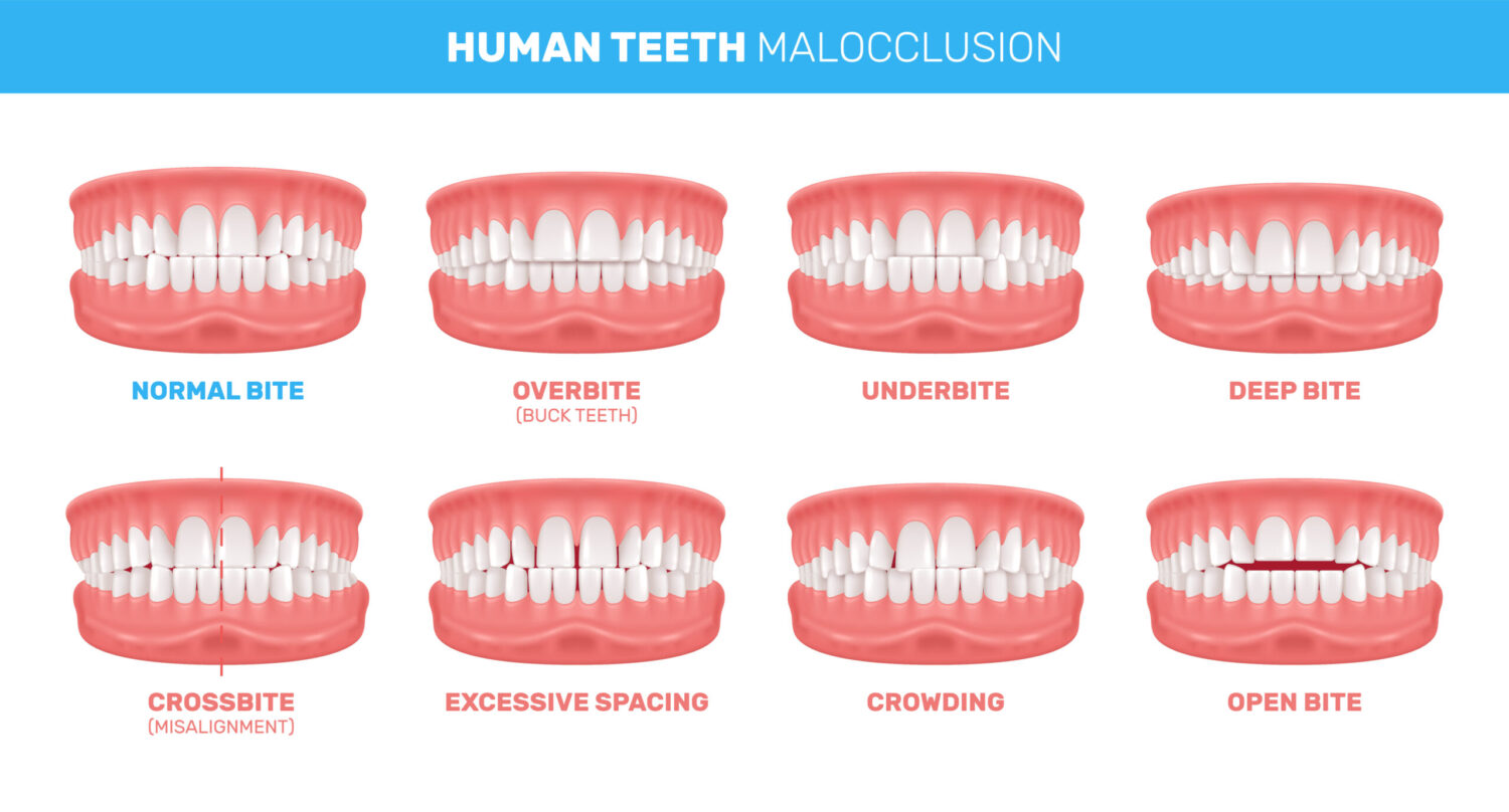 Graphic illustration of different types of malocclusion or bad bites