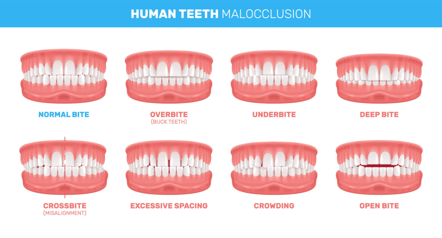 The Modern Approach to Overbite Correction with Invisalign