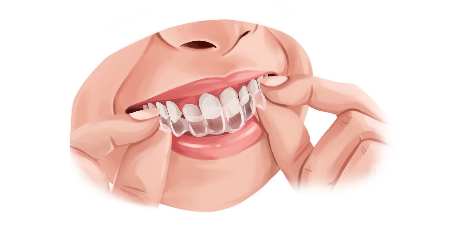 Illustration of a woman wearing Invisalign Clear aligners to straighten her teeth