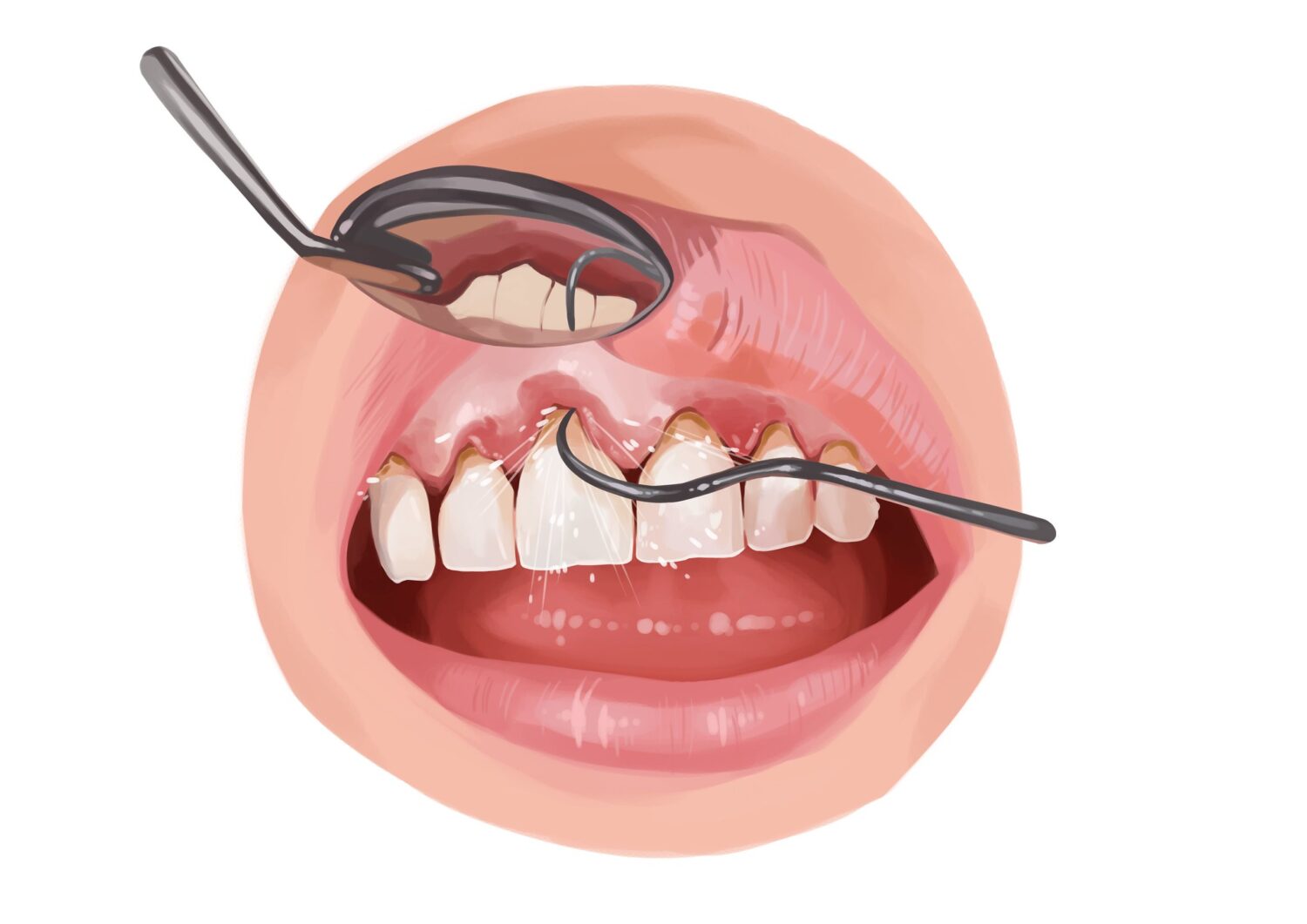 Illustration of a patient with gum disease receiving a deep cleaning at the dentist