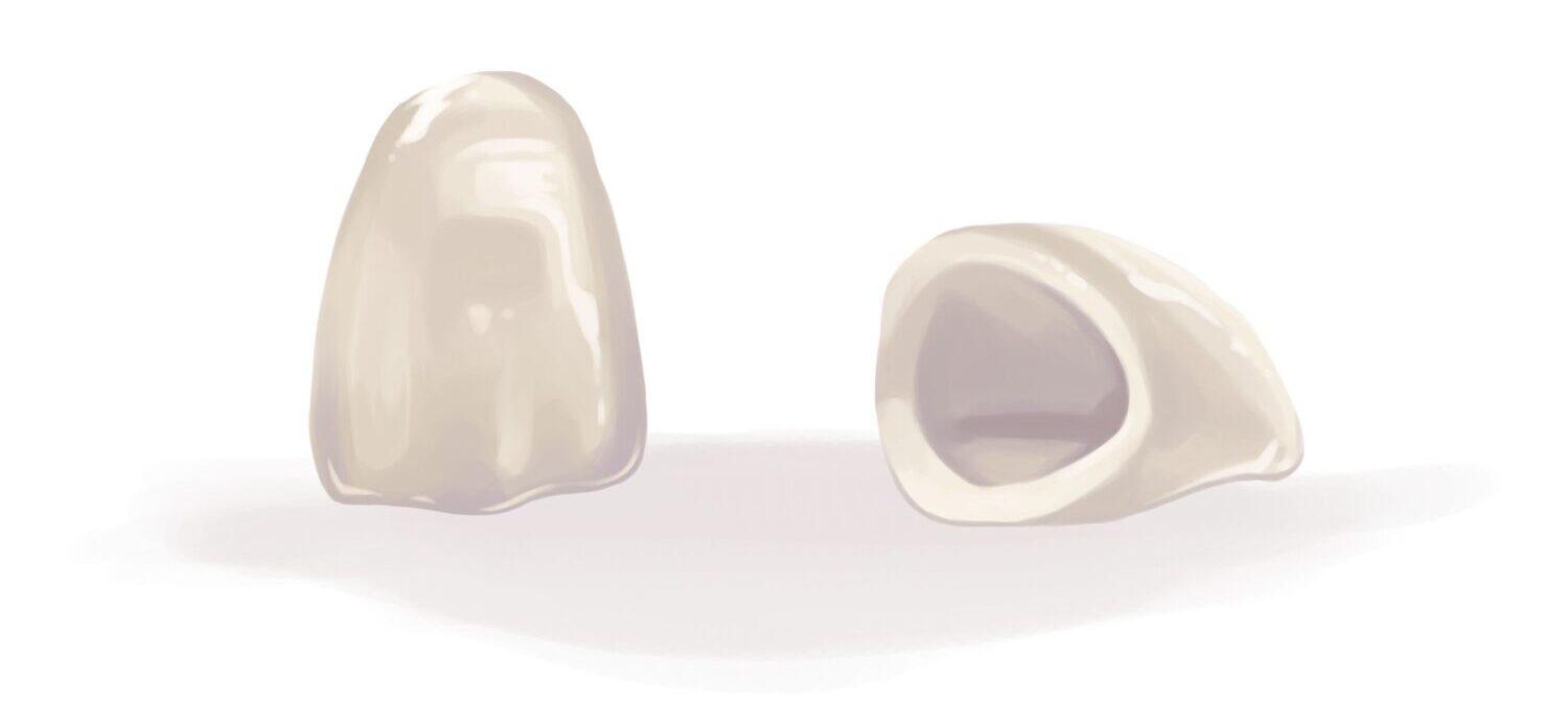 Illustration of 2 CEREC dental crowns to reinforce a damaged tooth