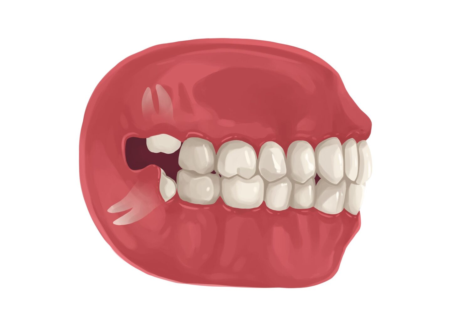 Illustration of a mouth with a partially impacted wisdom tooth that needs to be extracted