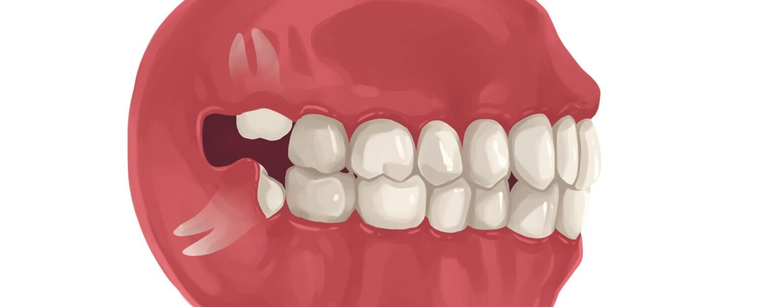 Drawing of gums with an impacted wisdom tooth that needs to be removed due to overcrowding