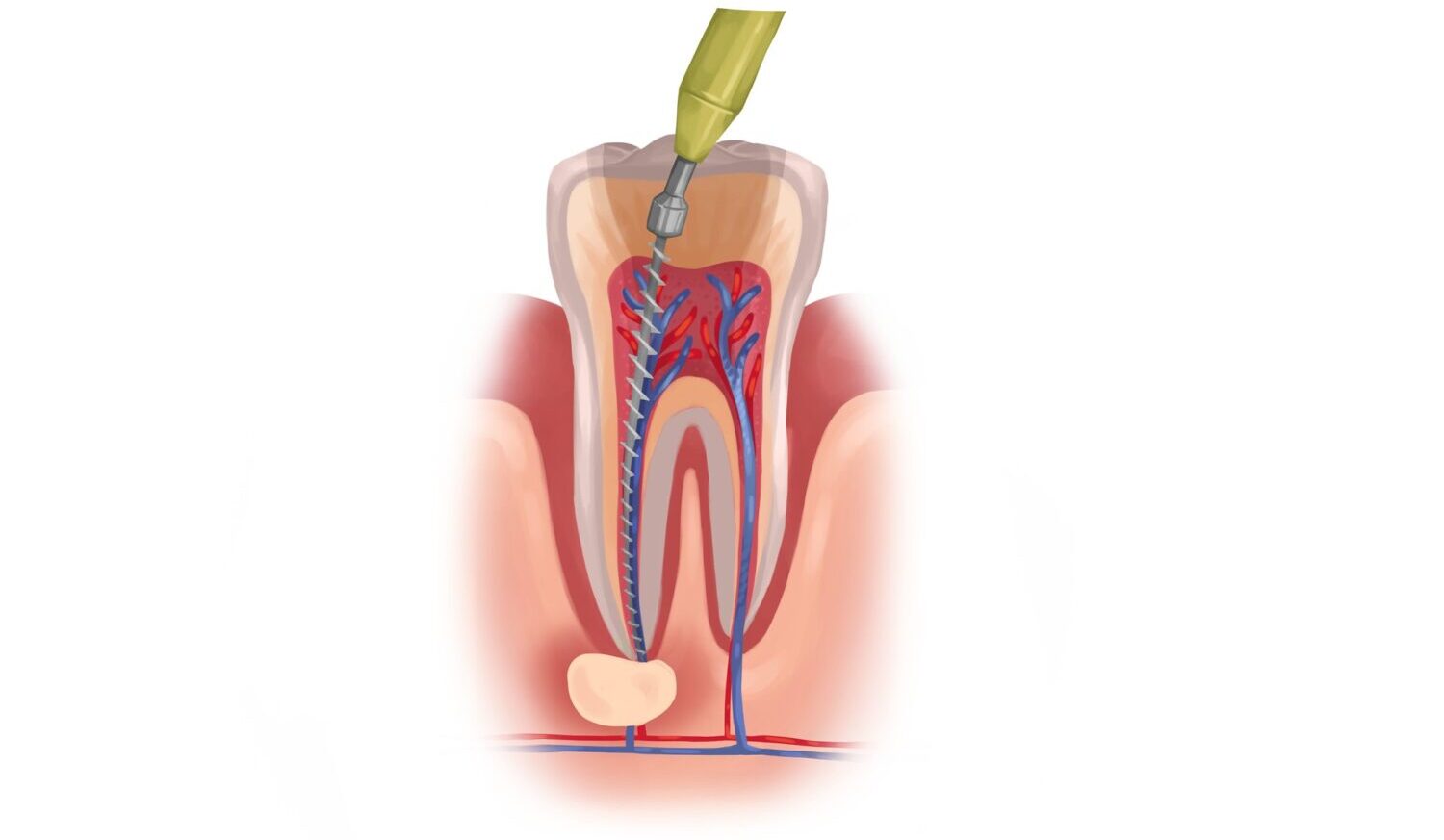 Drawing of a tooth receiving root canal therapy to preserve it