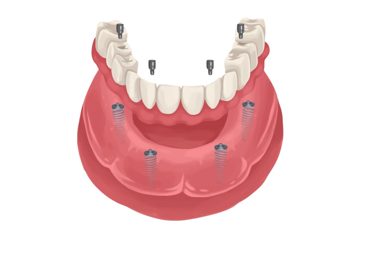 implant-supported denture, permanent denture, permanent dentures