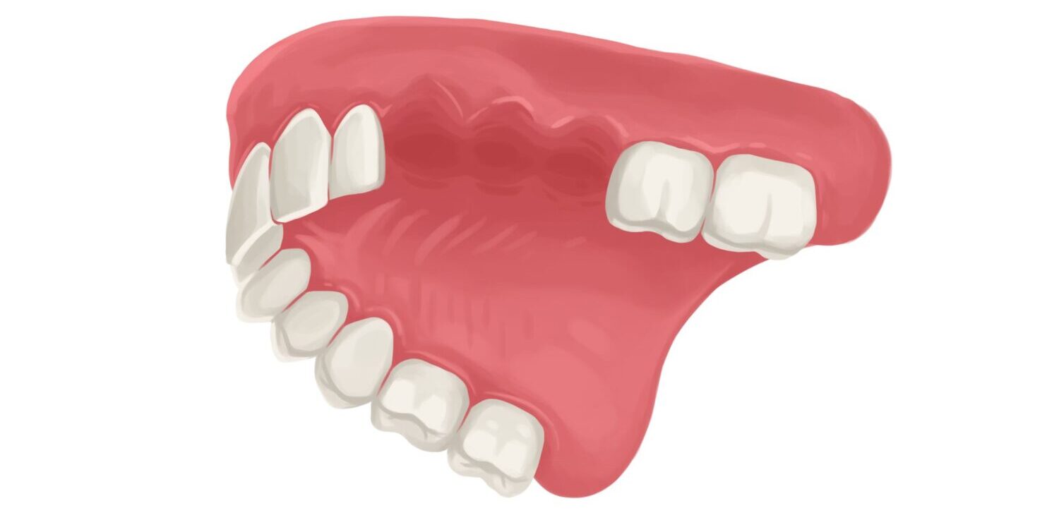 Drawing of upper gums with 3 missing teeth that need a durable tooth replacement