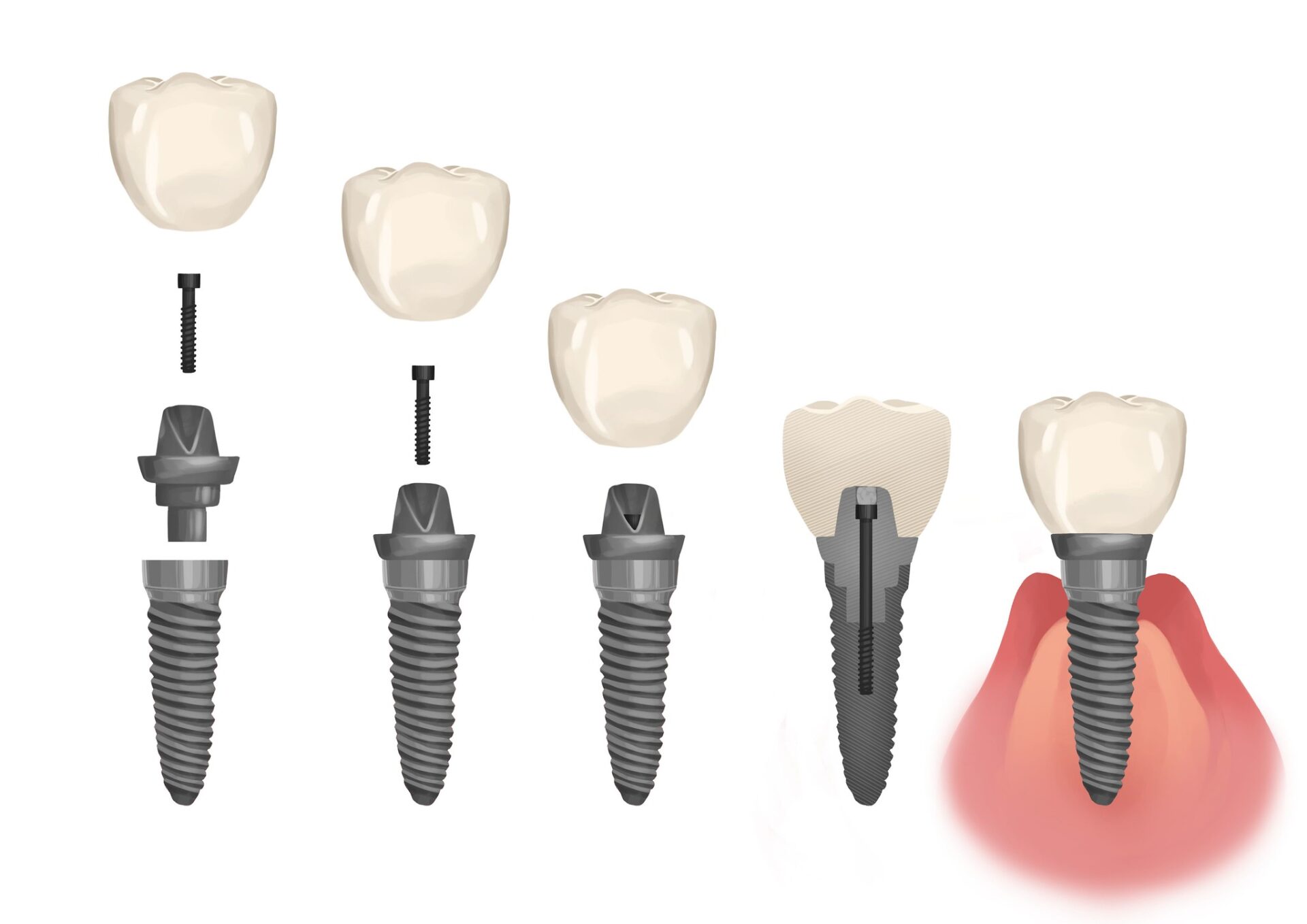 dental implant parts and cost