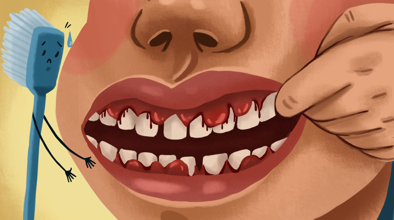 Illustration of a mouth with bleeding gums due to gum disease