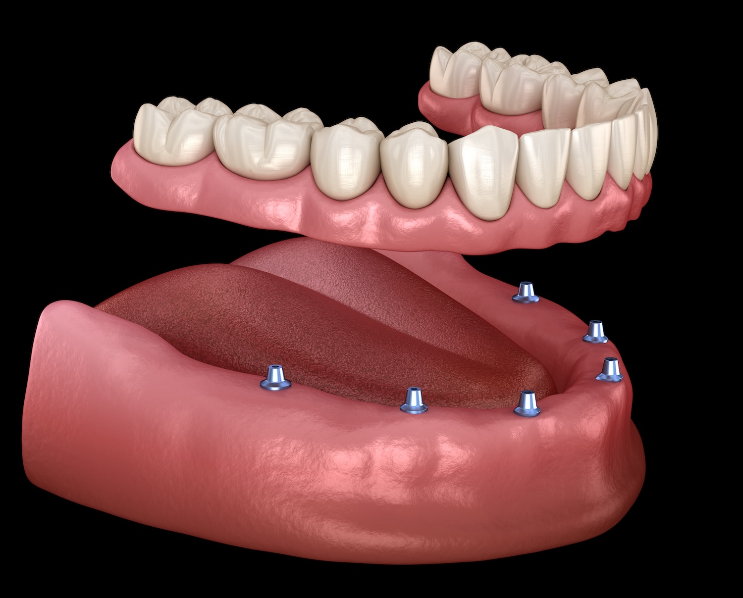 all-on-x denture on 6 dental implants, implant supported denture