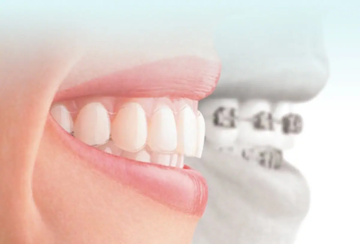CarolinasDentist-Invisalign-mobile-r1 braces smile after