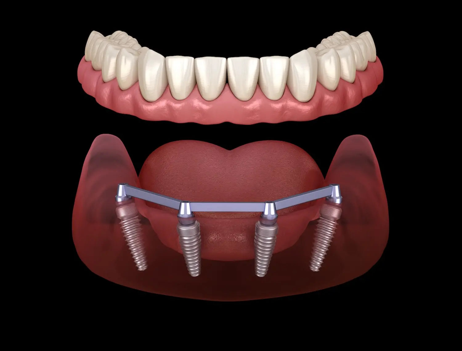 The Benefits Of All-On-X Dentures | CarolinasDentist | North Carolina