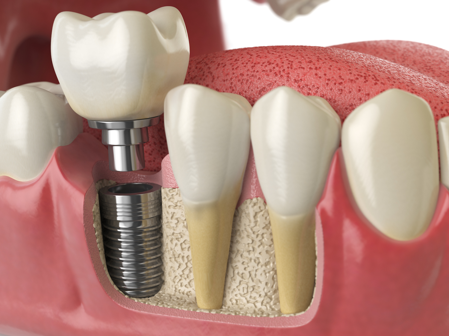 Closeup of a dental implant next to natural teeth, showing the roots implanted into the jawbone