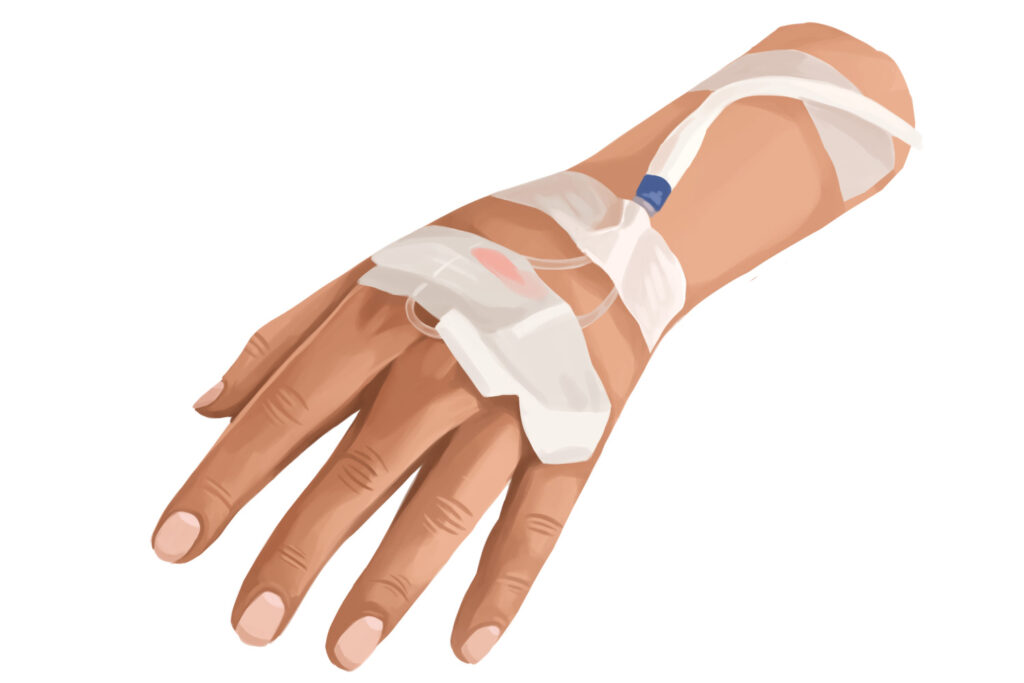 What Is IV Sedation Dentistry? CarolinasDentist