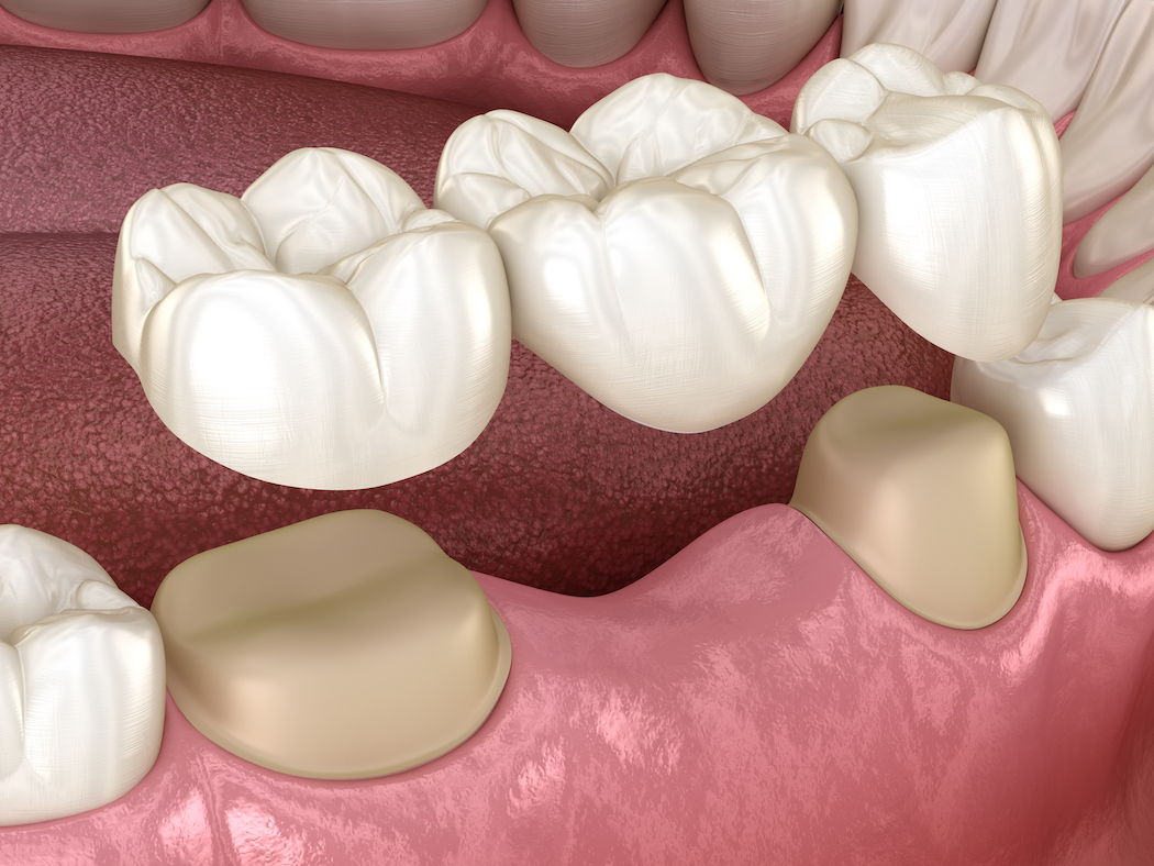 dental bridges, dental bridges, implant supported bridge, restorative dentistry
