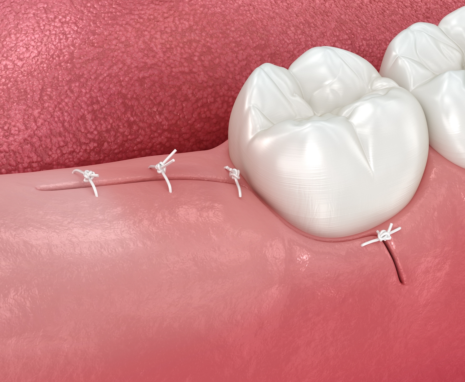 post op care for wisdom teeth removal, stitches, 3d medically accurate image of extraction site after wisdom tooth extraction