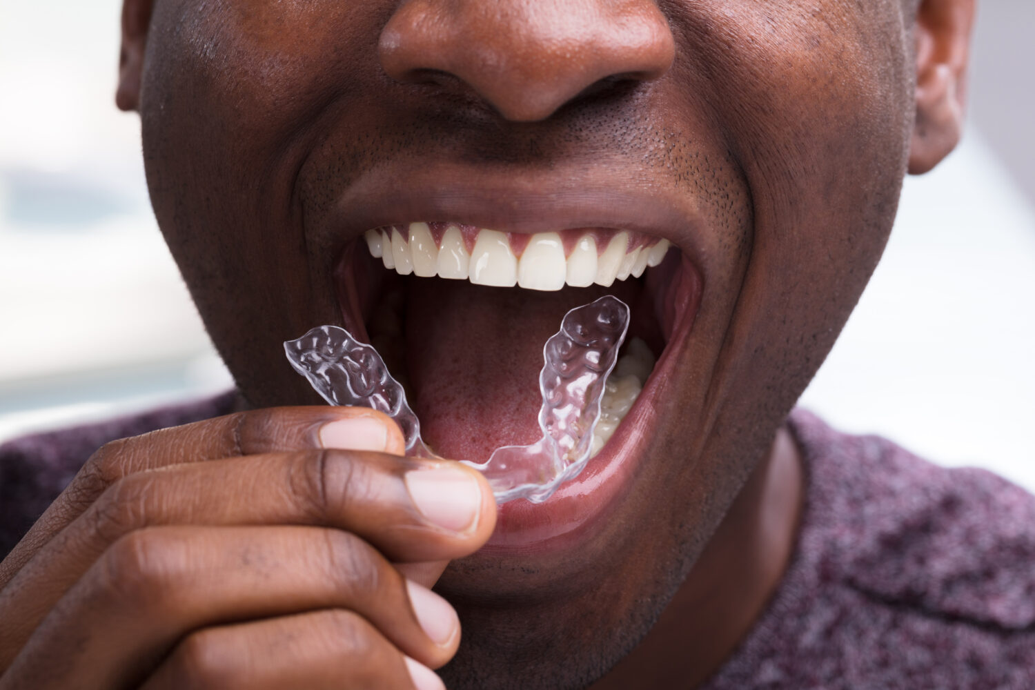 Clear Aligners: Byte or Invisalign?