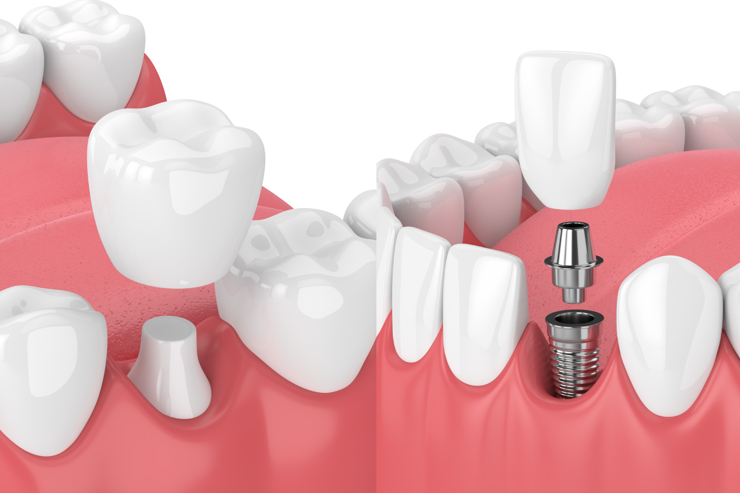 Closeup of a dental crown covering a natural tooth next to a dental crown topping a dental implant