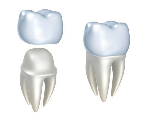 dental-crown-north-carolina dental crown