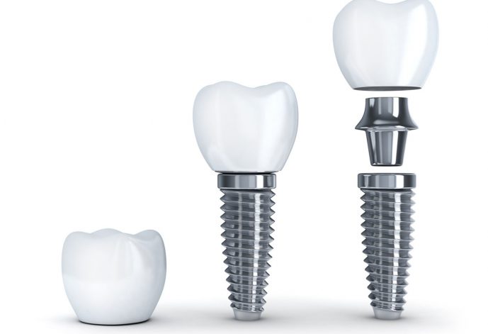 dental implant