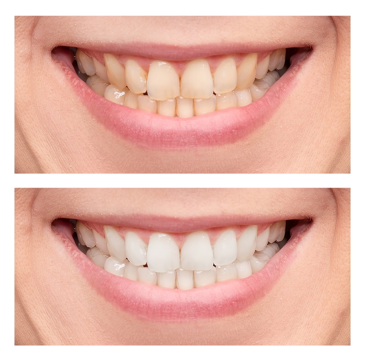 before and after of teeth whitening for the science of teeth whitening