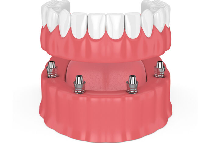 imp-dentures-1 imp-dentures-1