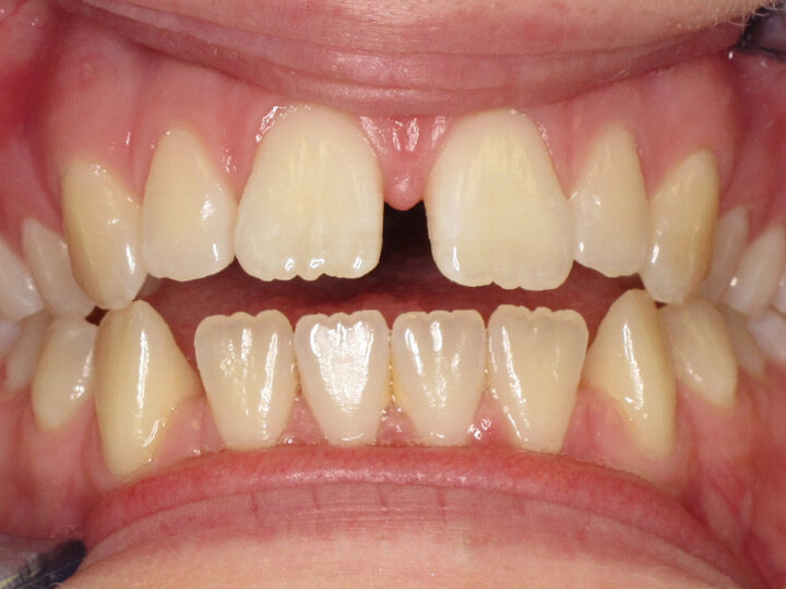 Invisalign Clear Aligners in North Carolina