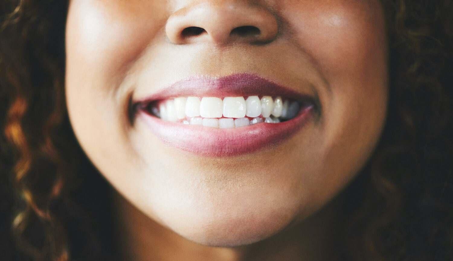 Closeup of a Black woman's smile after a smile makeover