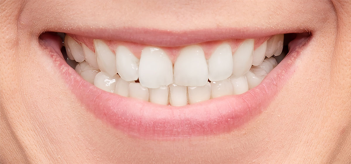 After teeth whitening