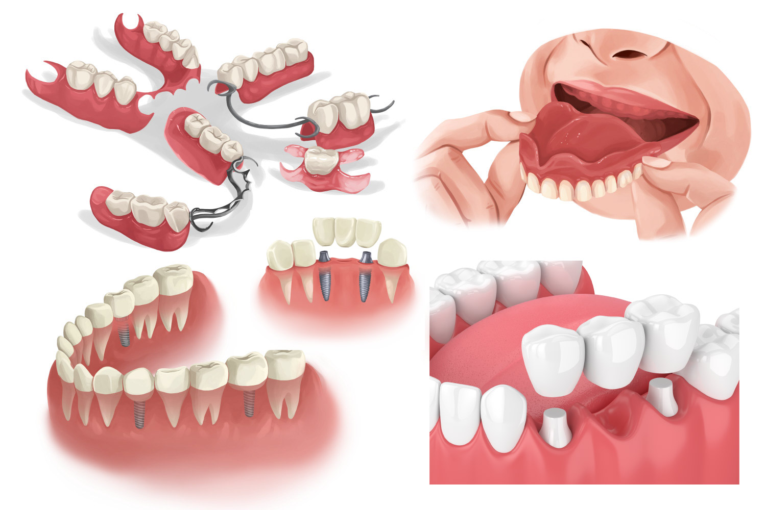 Drawings of tooth replacement options: dentures, bridges, and dental implants